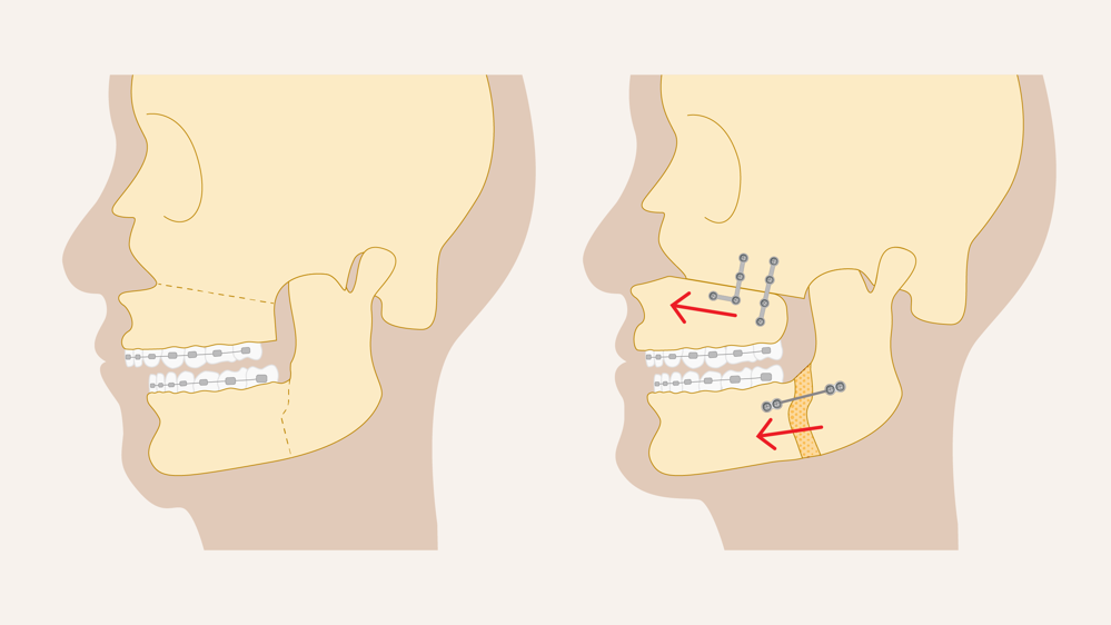 Illustratie van een kin verplaatsing