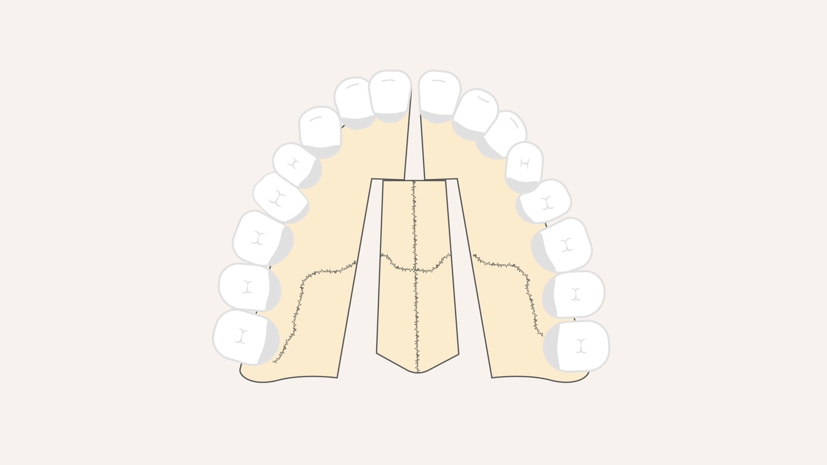 Een illustratie van de breuklijn van de bovenkaak bij een operatie. 