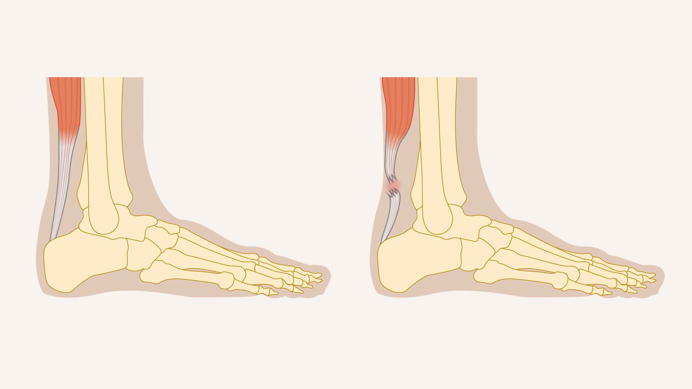 Illustratie van een gescheurde achillespees. 